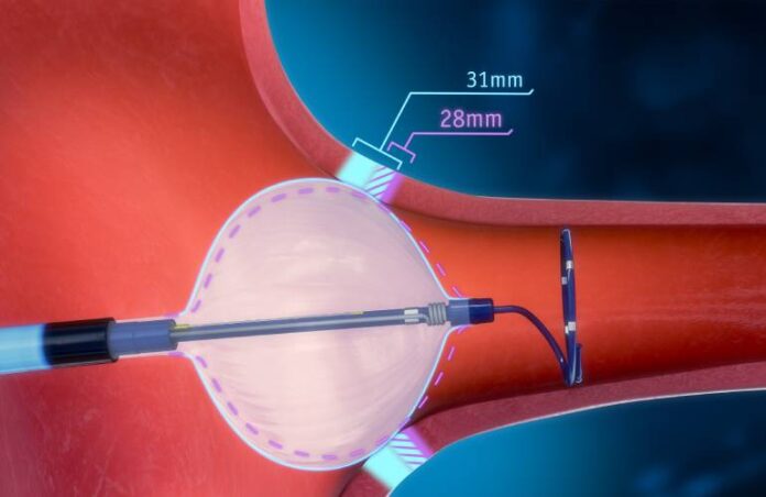 Boston-Scientific-POLARx-Cryoablation-system Le Maroc concerné par le rappel de 262.686 cathéters Boston Scientific